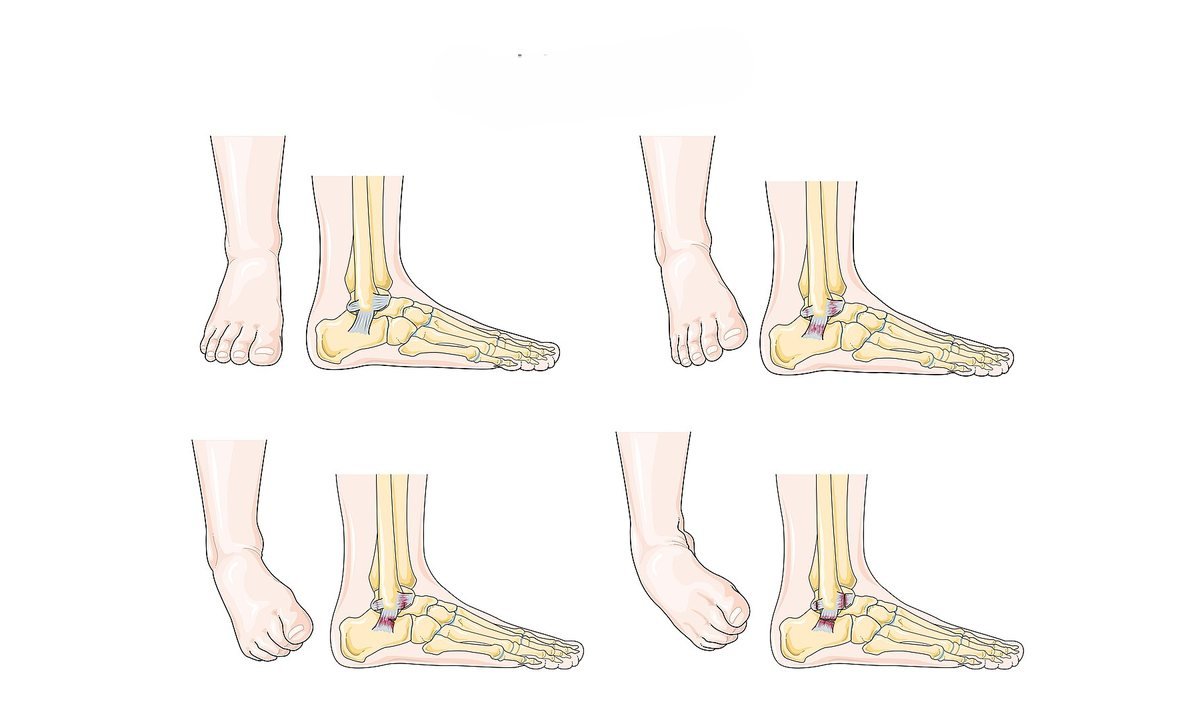 Sprained ankle: healing time, first aid and physio rehab