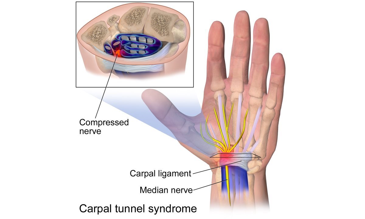 Carpal tunnel syndrome: symptoms, treatment and physio