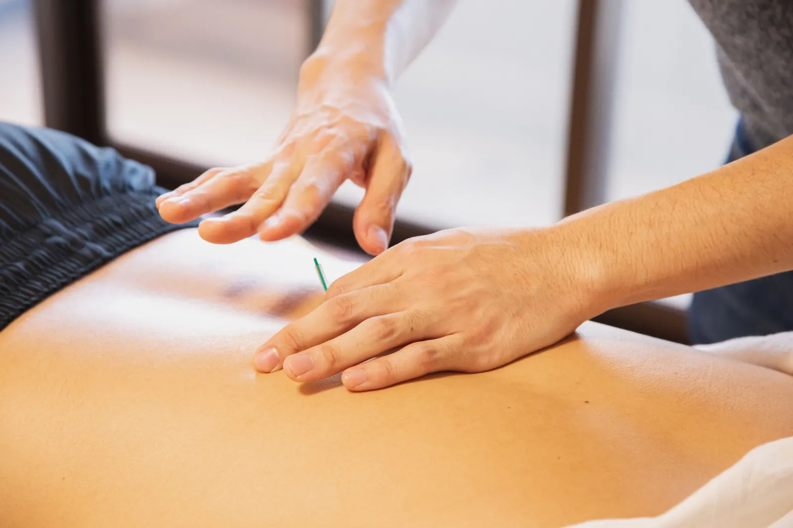 A physiotherapist placing a dry needle in a patient's lower back