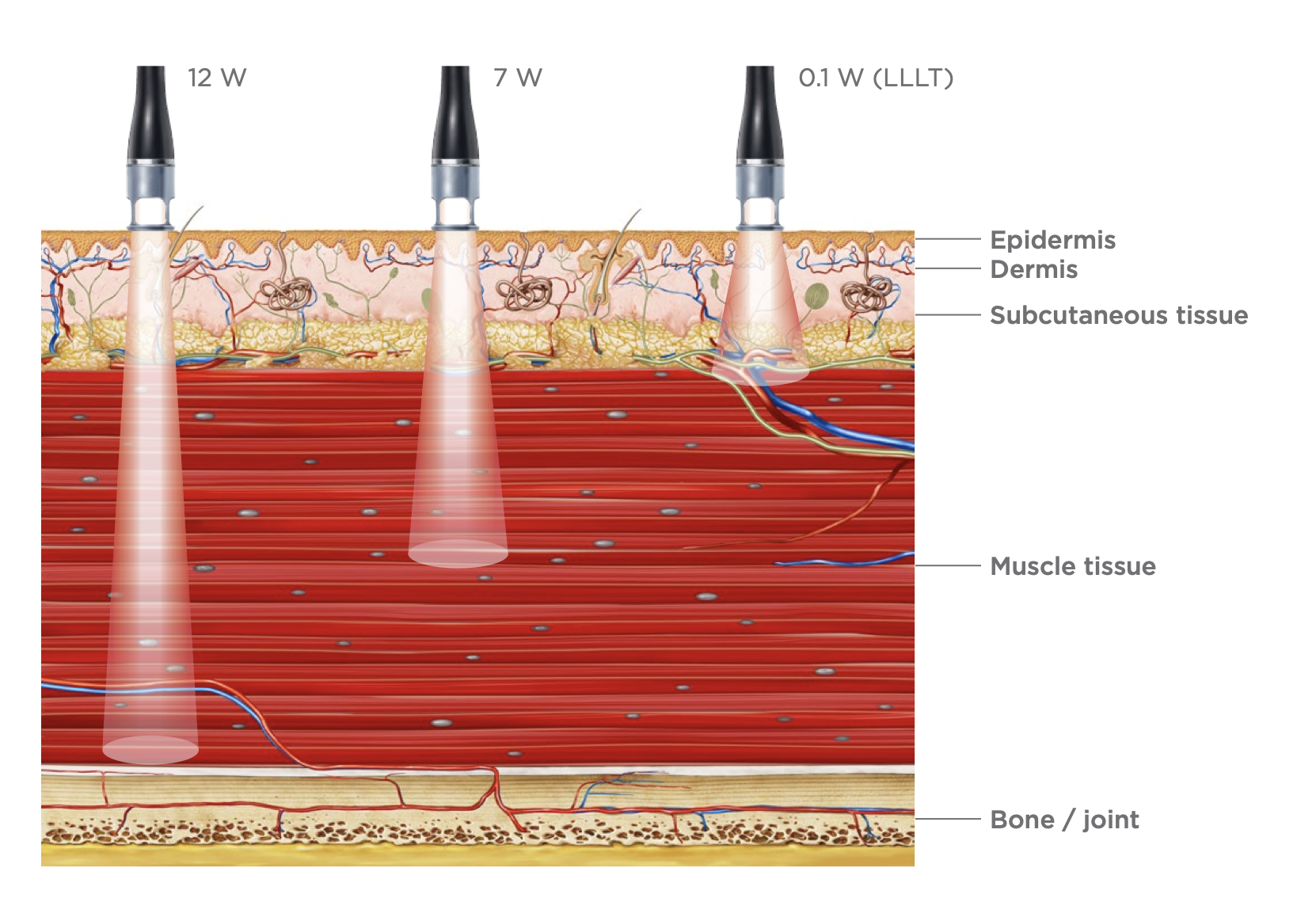 “Healing at the Speed of Light: Laser Therapy Now at UpPlus Physiotherapy”